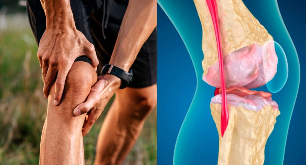 ¿Mi dolor de rodilla podría estar asociado a una lesión de los cartílagos?